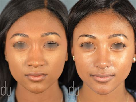 plastic surgeons that specialize in african american rhinoplasty